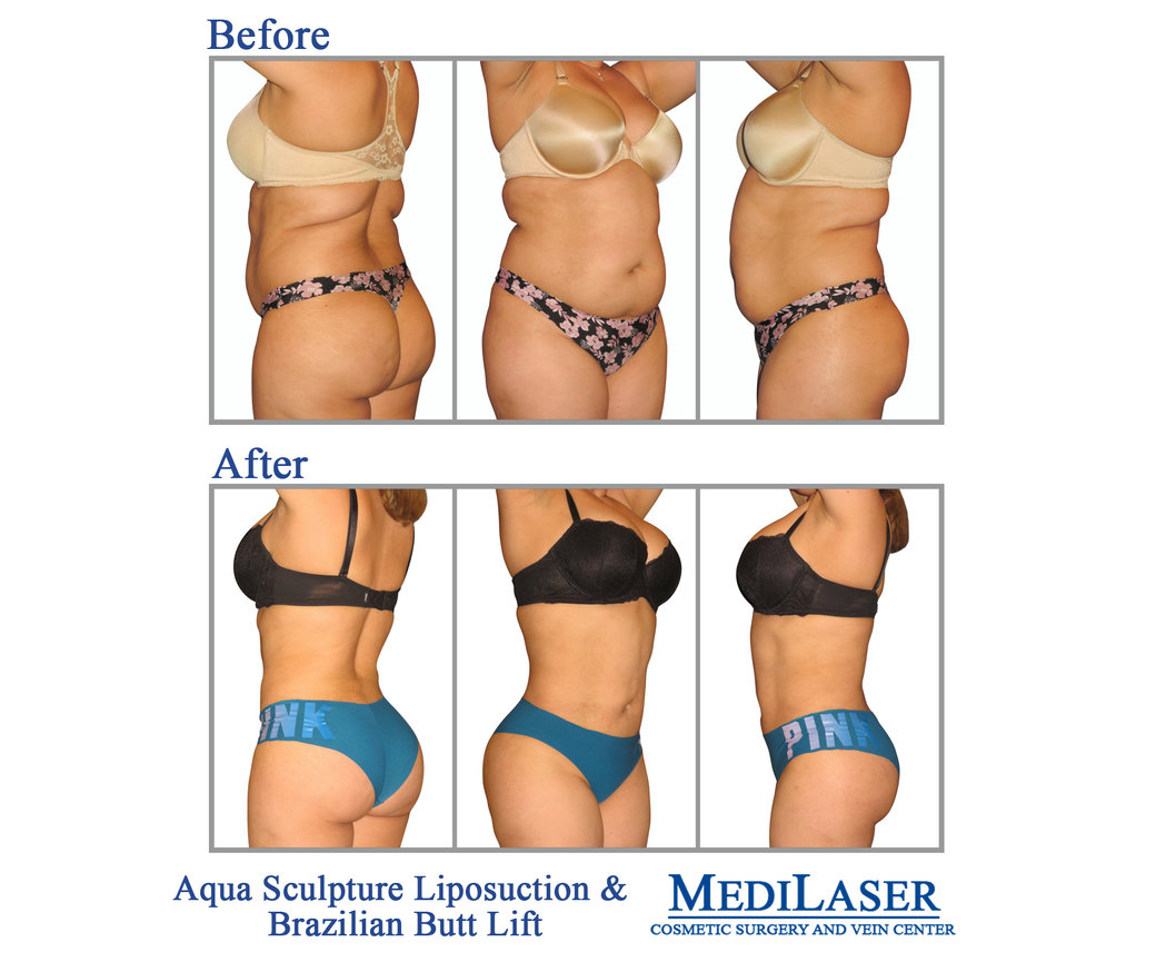 Liposuction Procedure in Plano TX - Fat Reduction Treatment