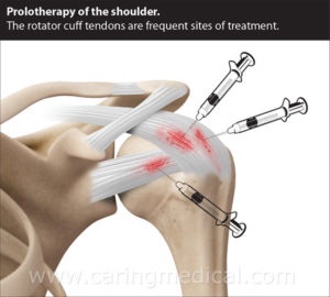 Rotator Cuff Surgical Repair Failure - The Orthobiologic Clinic