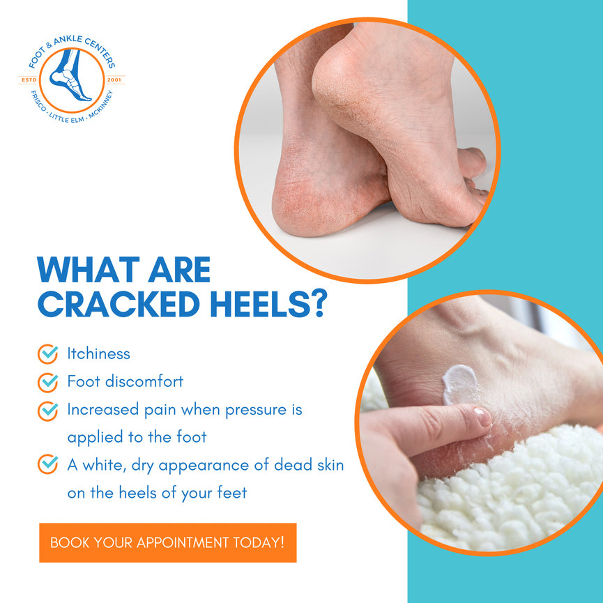 What Are Cracked Heels? in Frisco, Little Elm, and McKinney - Foot ...