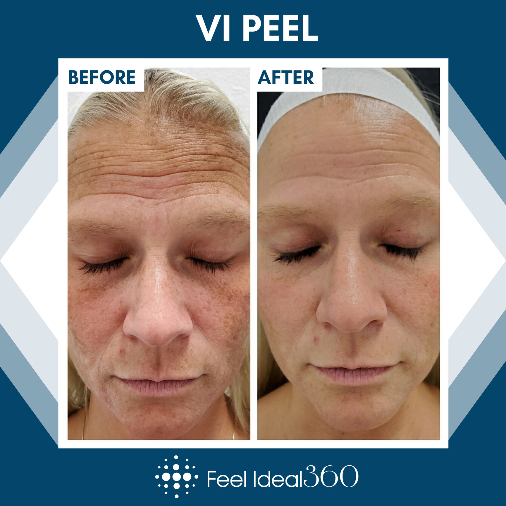 Specialty Before And After Feel Ideal 360 Med Spa Southlake Tx