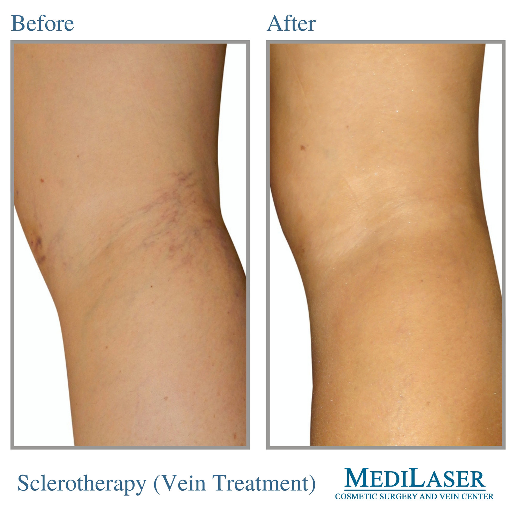 Sclerotherapy-Spider-Vein-Removal-Before-After - Medilaser Surgery and Vein  Center