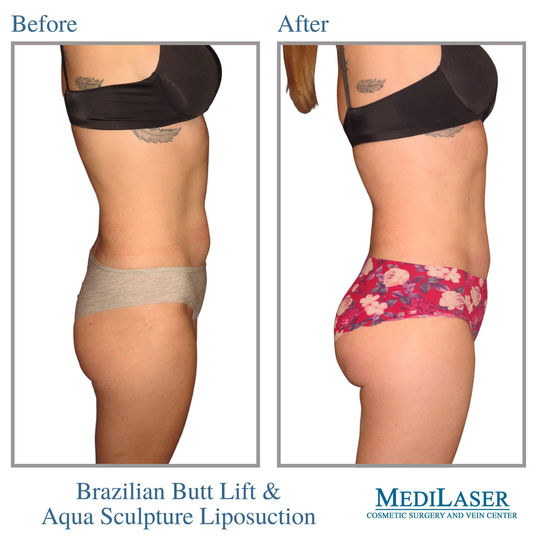 Brazilian Butt Lift Before and After - Medilaser Surgery and Vein