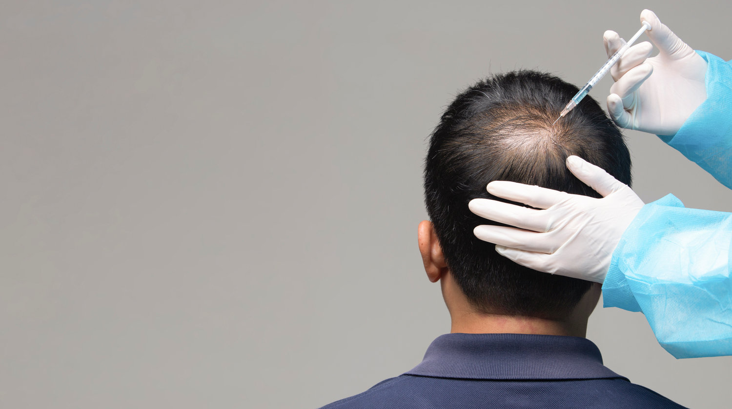 Hair Growth (PRP) Treatment in Dallas, TX | OMNI SCULPT MD