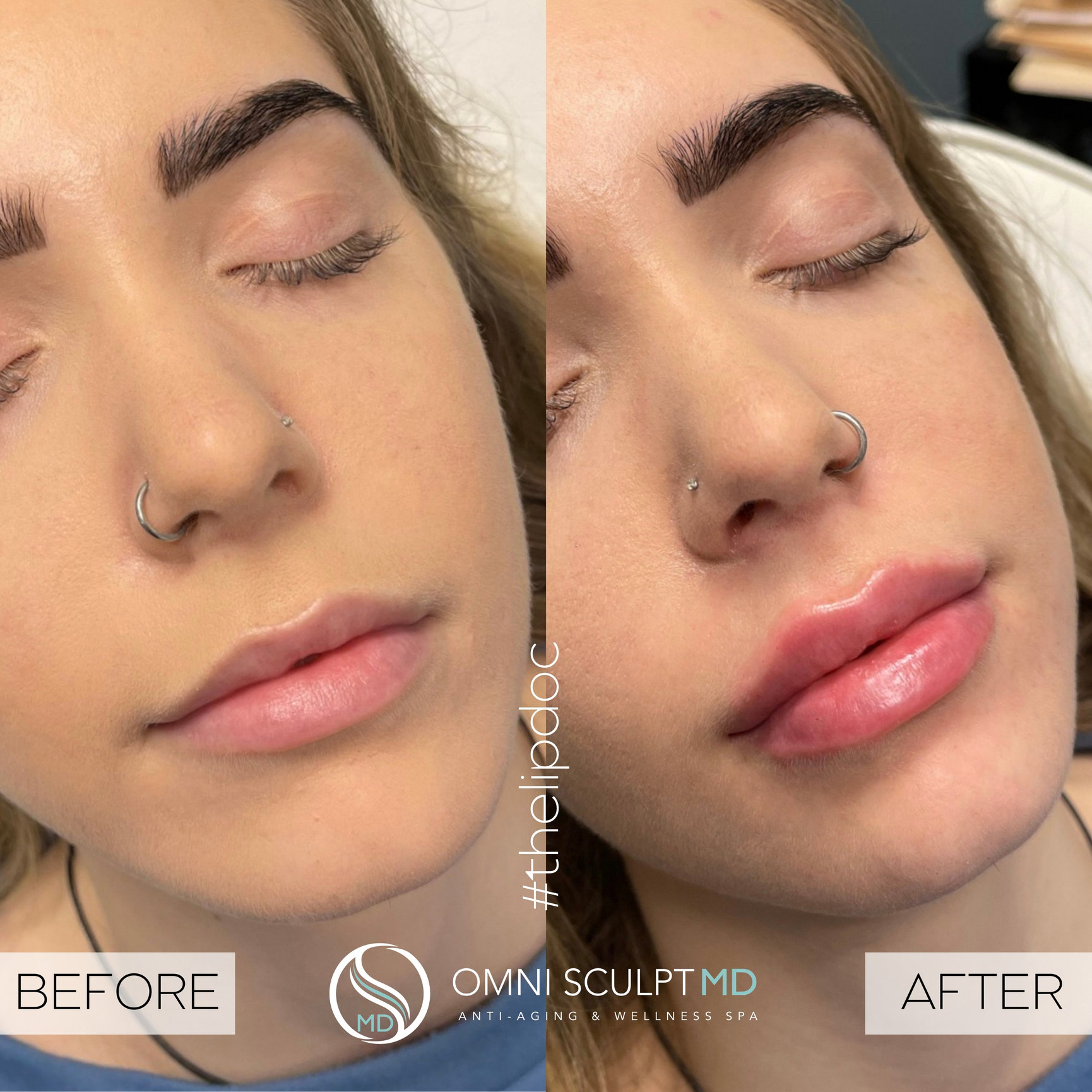 Lip Injection Before & After Gallery OMNI SCULPT MD