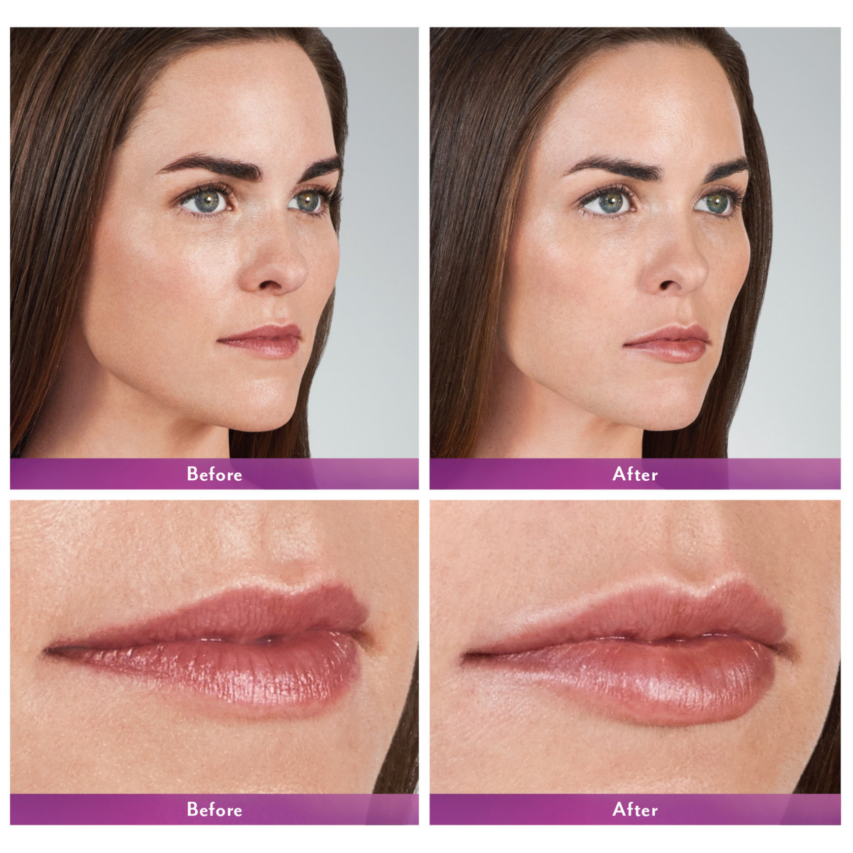 Lip Filler Before and After Feel Ideal 360 Med Spa Southlake, TX
