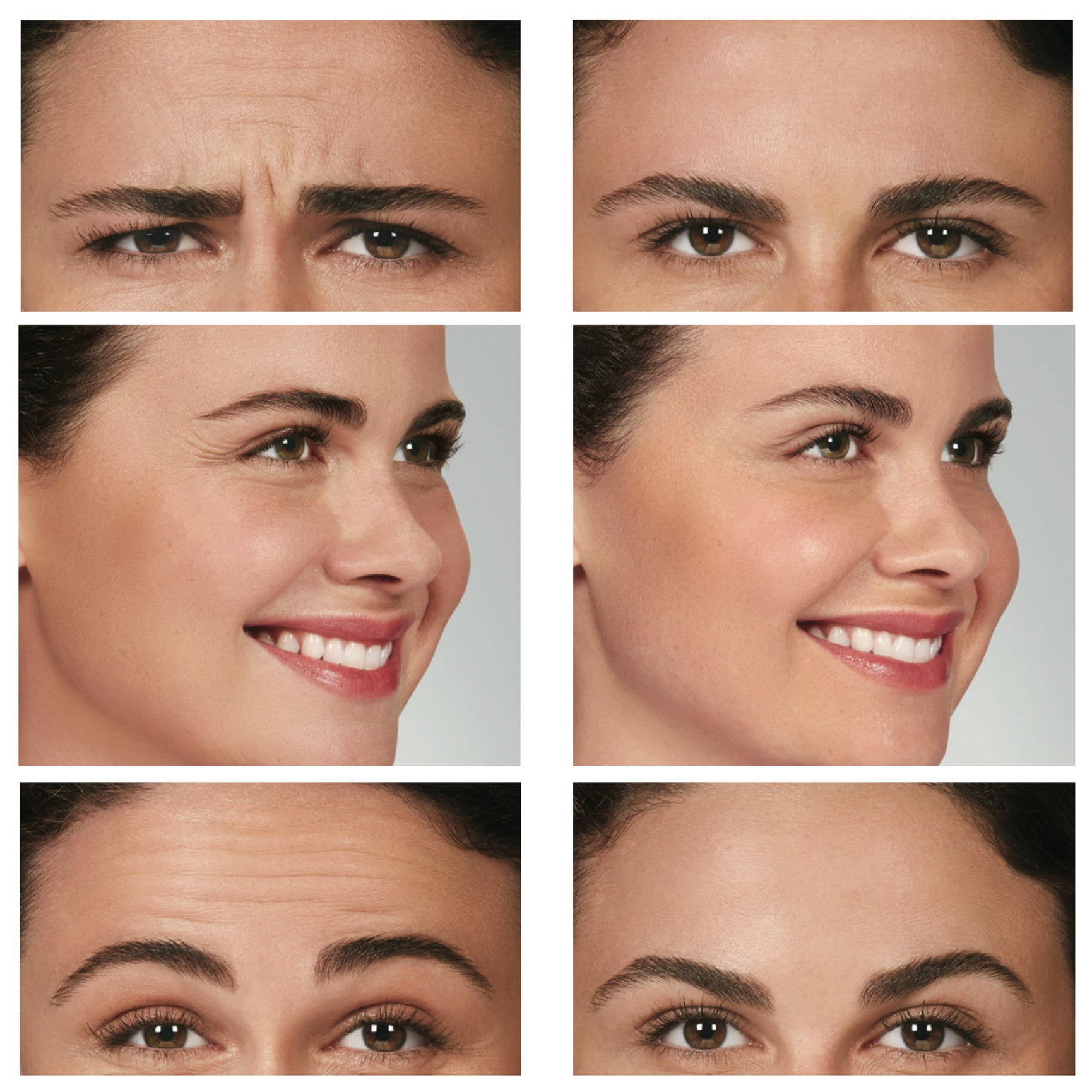 Botox Before And After Feel Ideal 360 Med Spa Southlake TX